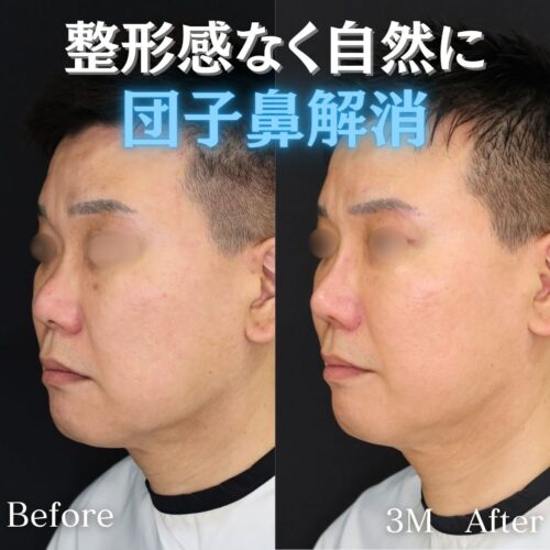 症例解説：整形感なく自然に団子鼻解消